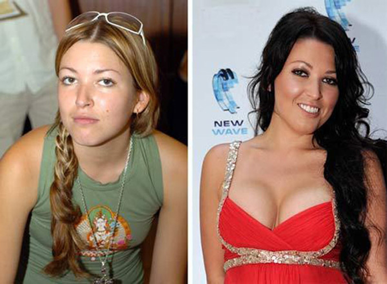 Российские знаменитости до и после пластики фото 12