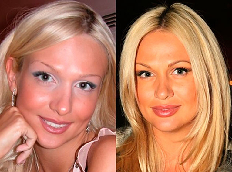 Российские знаменитости до и после пластики фото 17