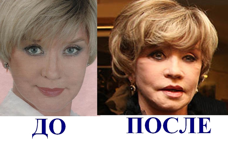 Российские знаменитости до и после пластики фото 18