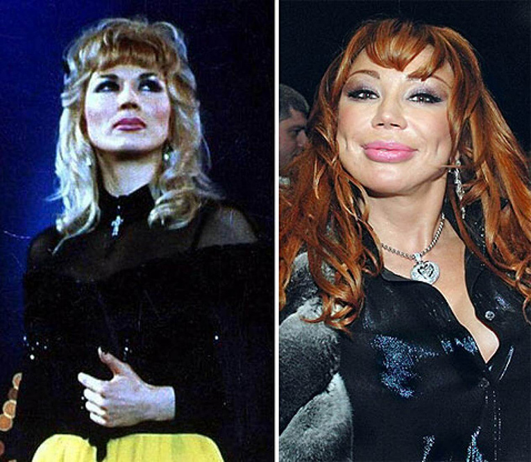 Российские знаменитости до и после пластики фото 2