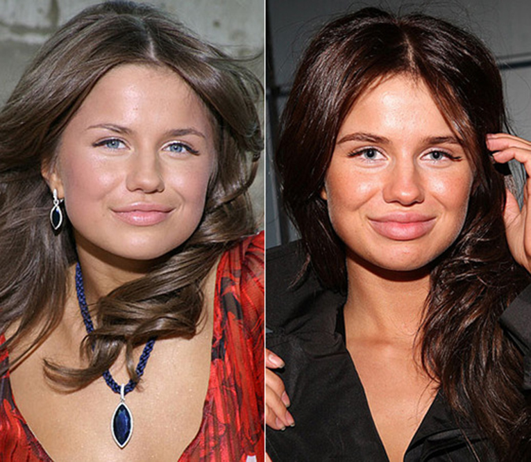 Российские знаменитости до и после пластики фото 4